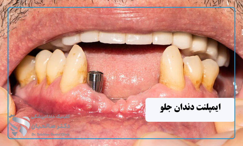 ایمپلنت دندان جلو فک پایین