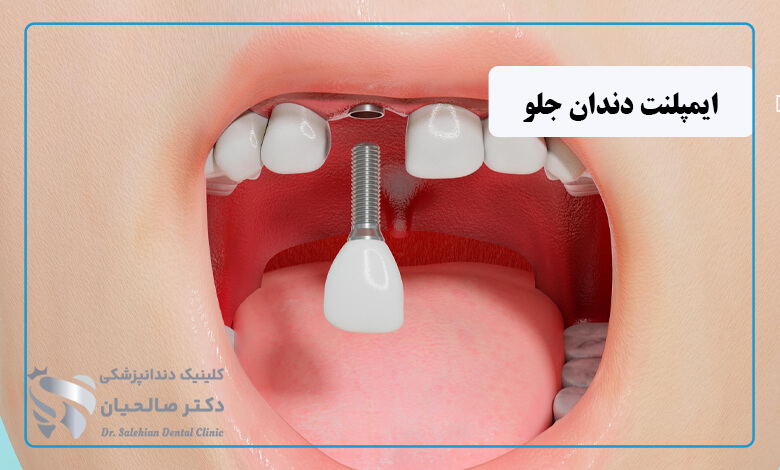 ایمپلنت دندان جلو چگونه است؟