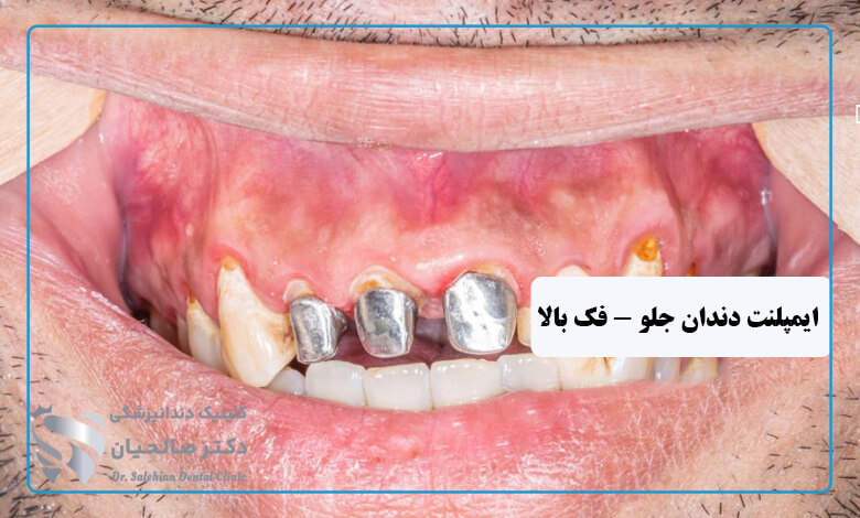 ایمپلنت دندانهای جلو فک بالا و پایین