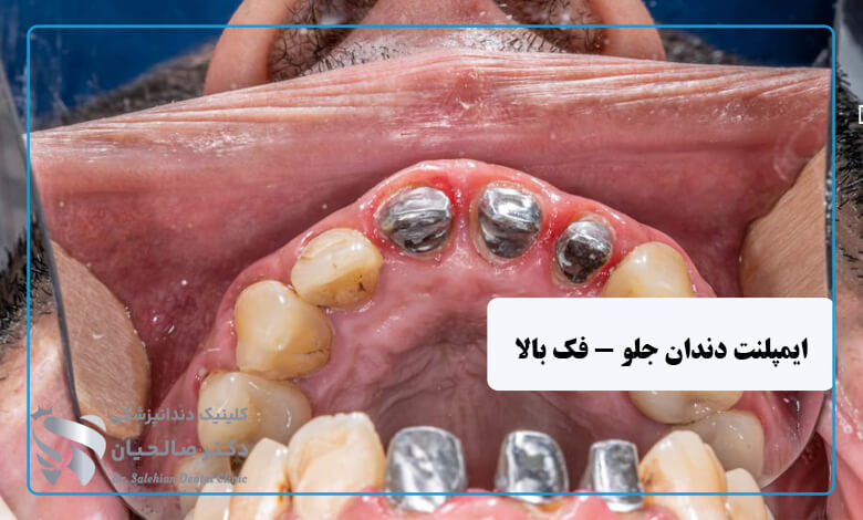 ایمپلنت دندان جلو فوری فک بالا