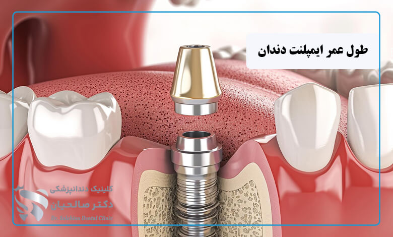 طول عمر ایمپلنت دندان