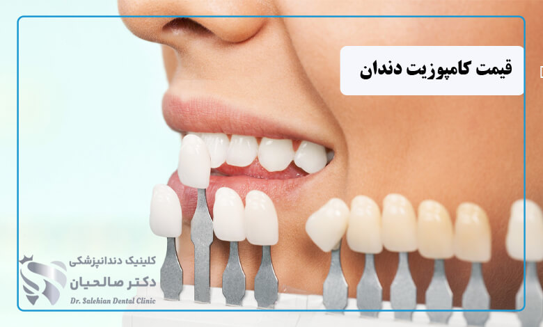 عوامل تاثیرگذار بر قیمت کامپوزیت دندان