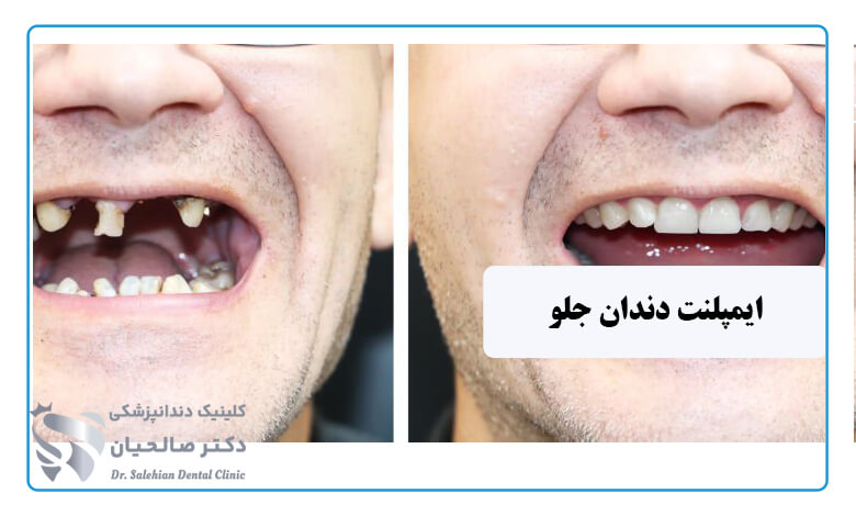 ایمپلنت دندان جلو فک بالا