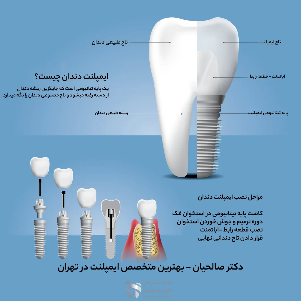 اینفوگرافیک ایمپلنت دندان