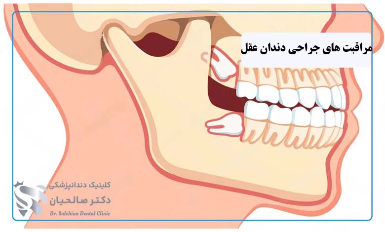 مراقبت های قبل و بعد از جراحی دندان عقل