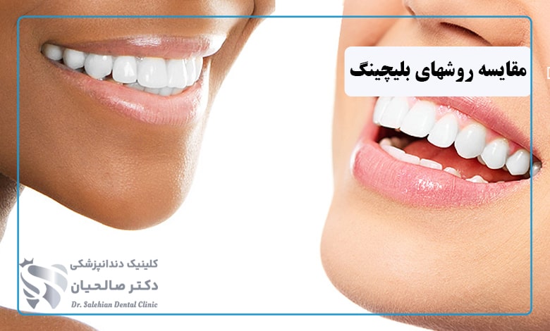 مقایسه بلیچینگ در خانه و مطب