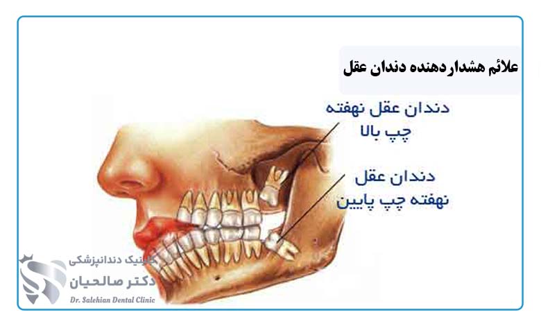 علائم هشدار دهنده دندان عقل نهفته