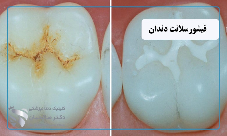 قبل و بعد از فیشورسیلانت