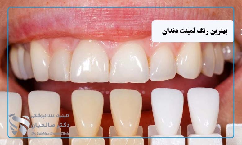 بهترین رنگ لمینت دندان