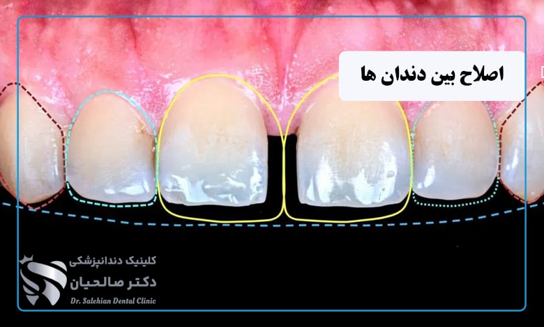 اصلاح بین دندانها