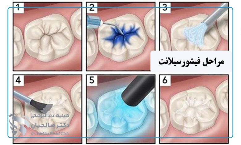 مراحل درمان فیشورسیلانت