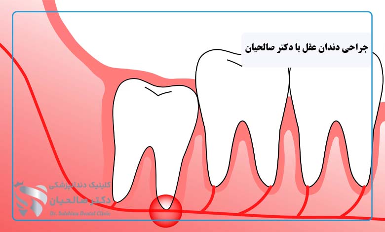 جراحی دندان عقل در کلینیک دندانپزشکی دکتر صالحیان