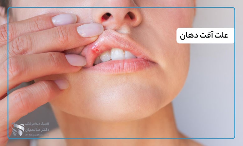 علل آفت دهان