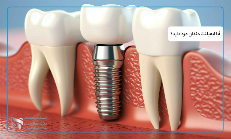 آیا ایمپلنت دندان درد دارد؟