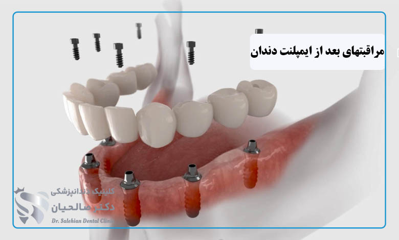 مراقبت های بعد از ایمپلنت دندان