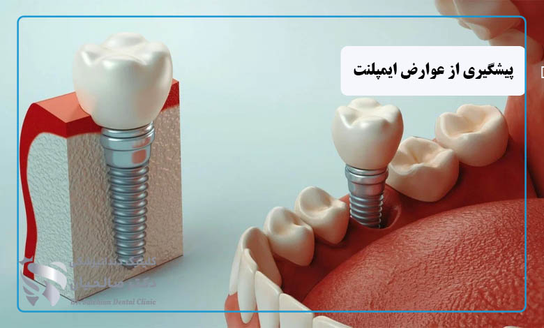 پیشگیری از عوارض ایمپلنت دندان