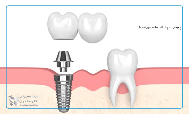 چه زمانی بریج انتخاب مناسب تری است؟