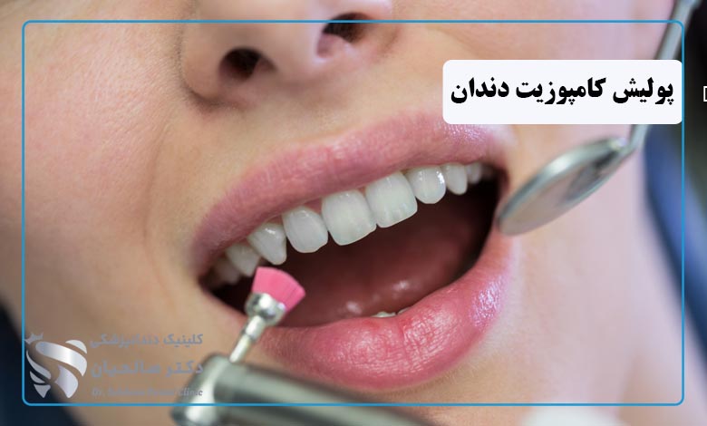 پولیش کامپوزیت دندان چیست؟ چگونه انجام میشود؟