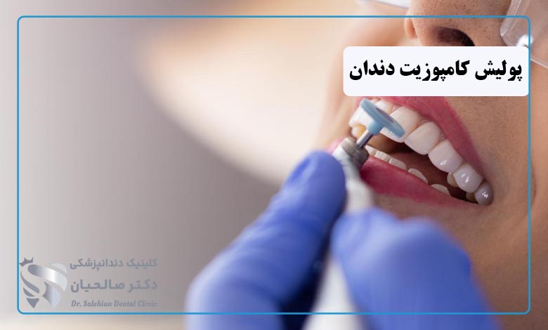 پولیش کامپوزیت دندان چیست