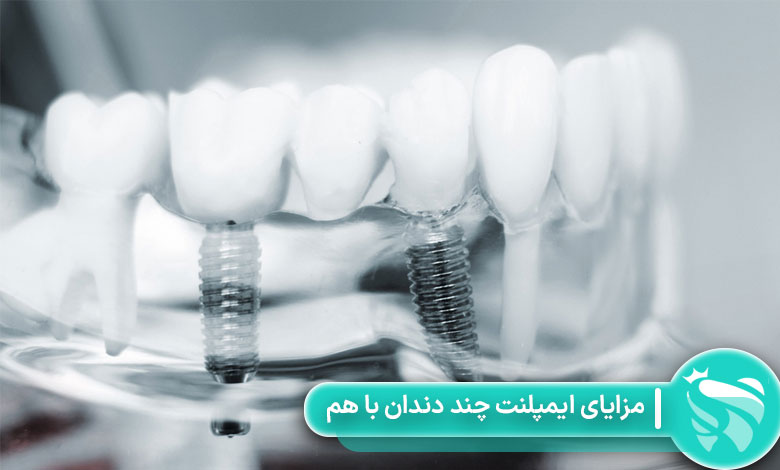 مزایای ایمپلنت چند دندان با هم