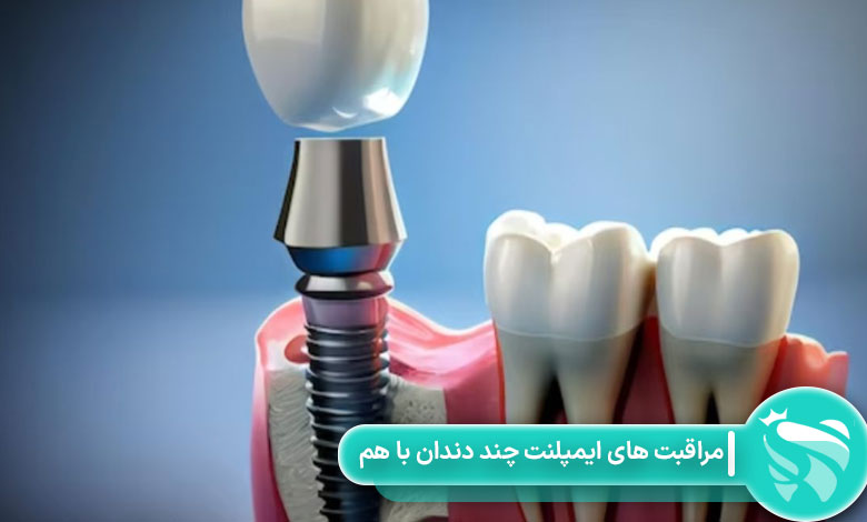 مراقبت های ایمپلنت چند دندان با هم