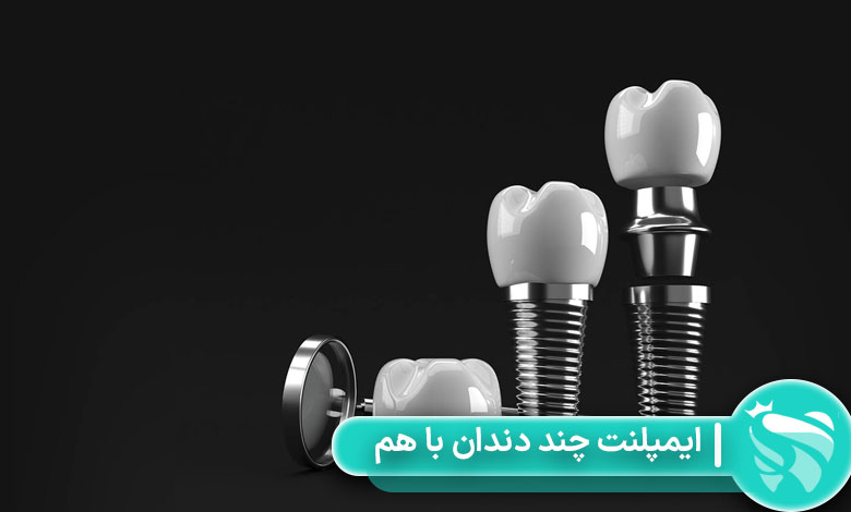 ایمپلنت چند دندان با هم