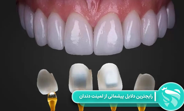 رایجترین دلایل پیشمانی از لمینت دندان