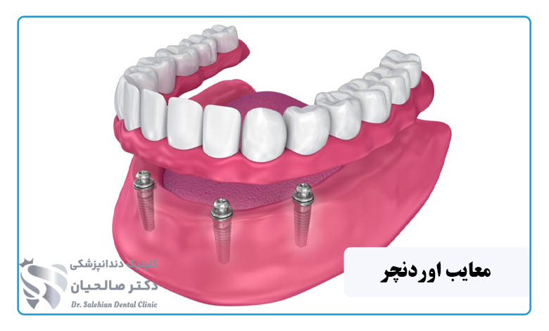 معایب اوردنچر