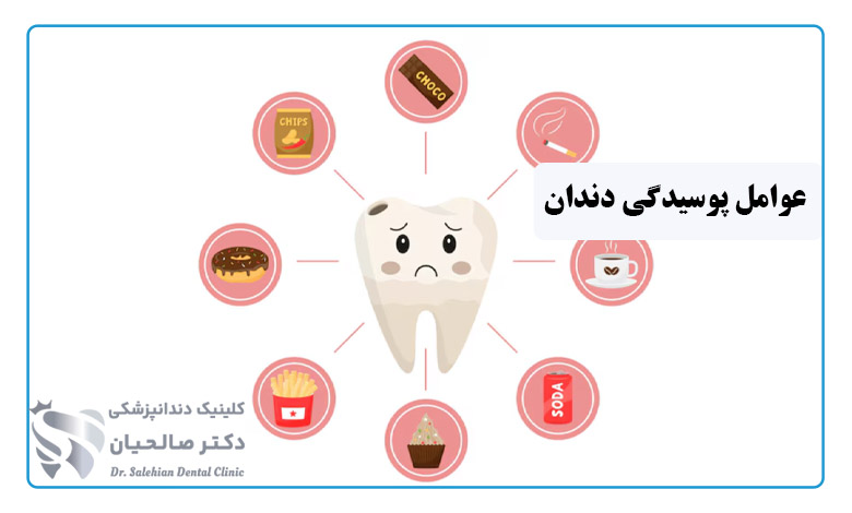 پوسیدگی دندان چگونه بوجود می‌آید؟