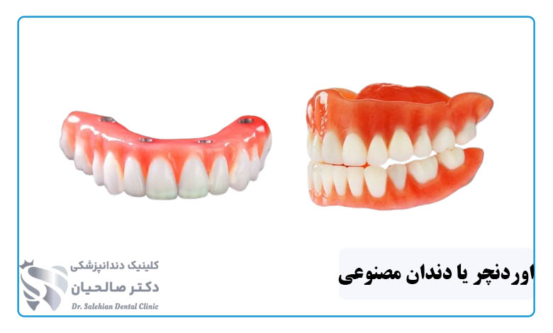 تفاوت اوردنچر و دندان مصنوعی چیست؟