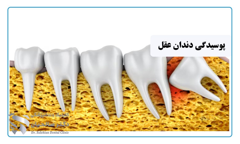 پوسیدگی دندان عقل