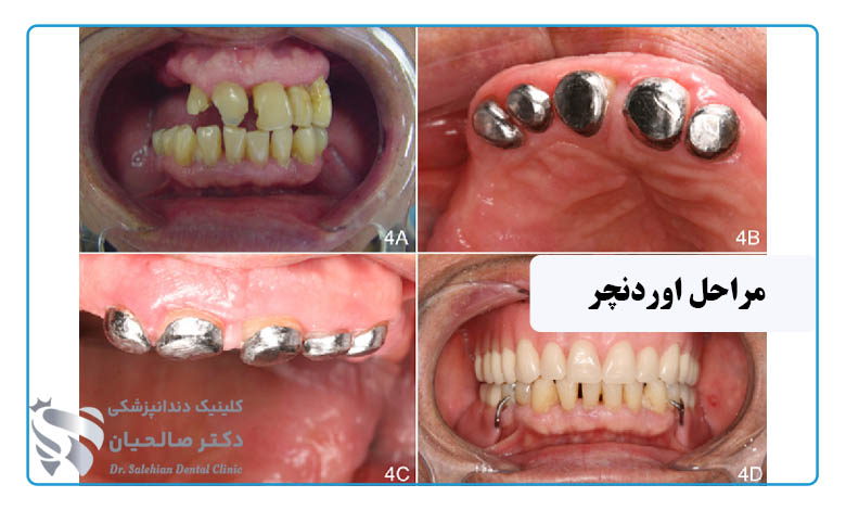 مراحل انجام اوردنچر