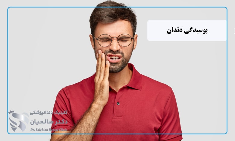 پوسیدگی دندان