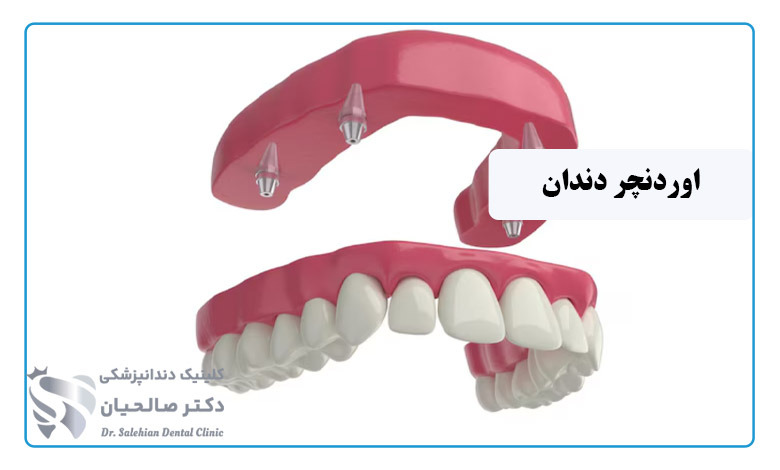 اوردنچر دندان چیست