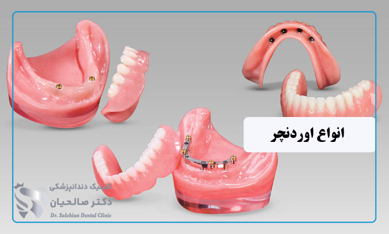 انواع اوردنچر دندان