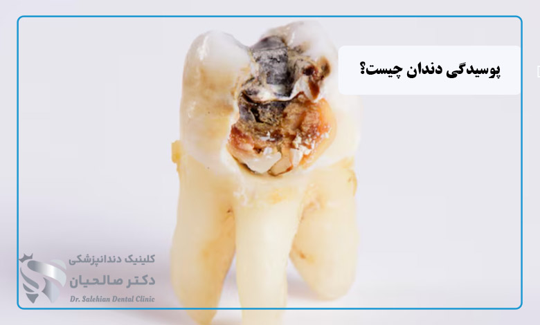 پوسیدگی دندان چیست