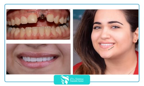 نمونه کار ایمپلنت دندان دکتر صالحیان